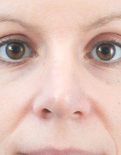 Rhinoplasty Before & After Gallery - Patient 196888 - Image 1