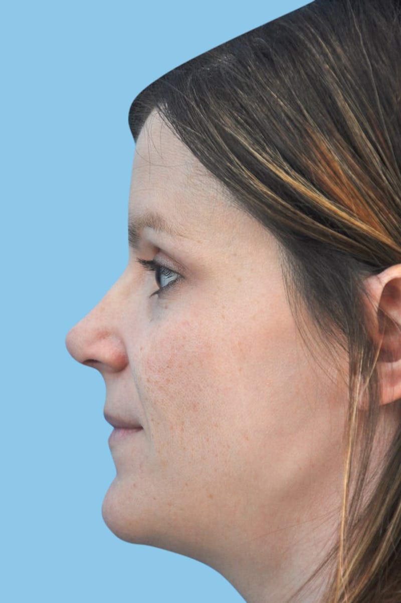 Rhinoplasty Before & After Gallery - Patient 285994 - Image 4