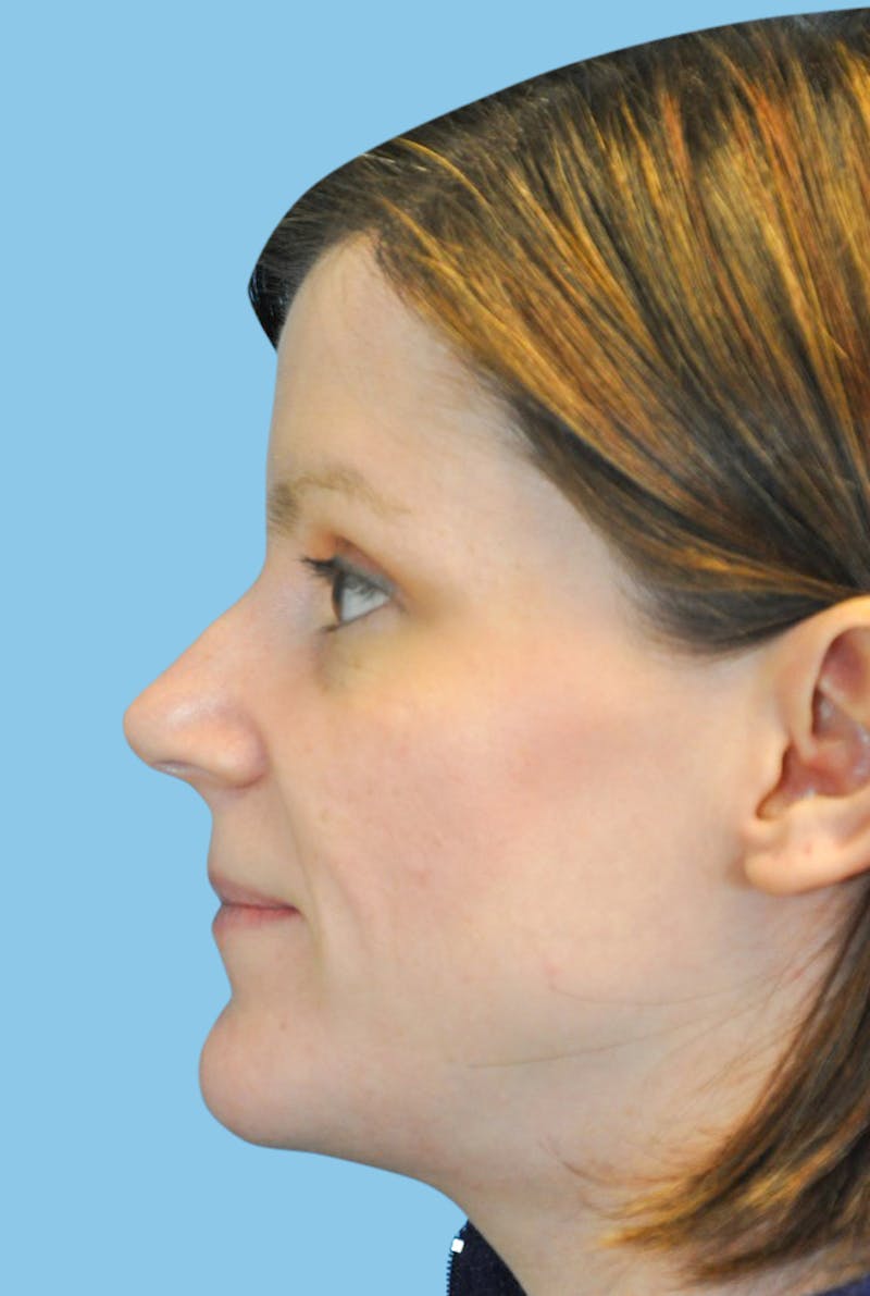 Rhinoplasty Before & After Gallery - Patient 285994 - Image 3