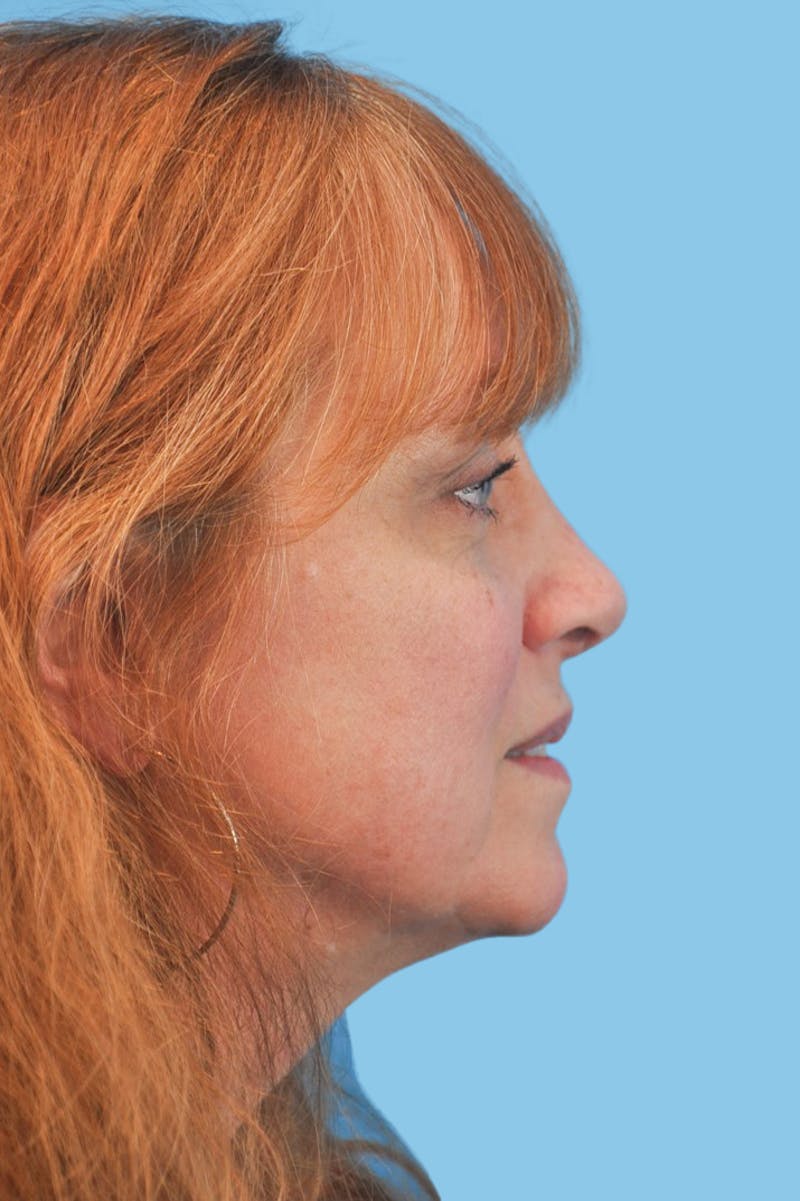 Revision Rhinoplasty Before & After Gallery - Patient 141207 - Image 4
