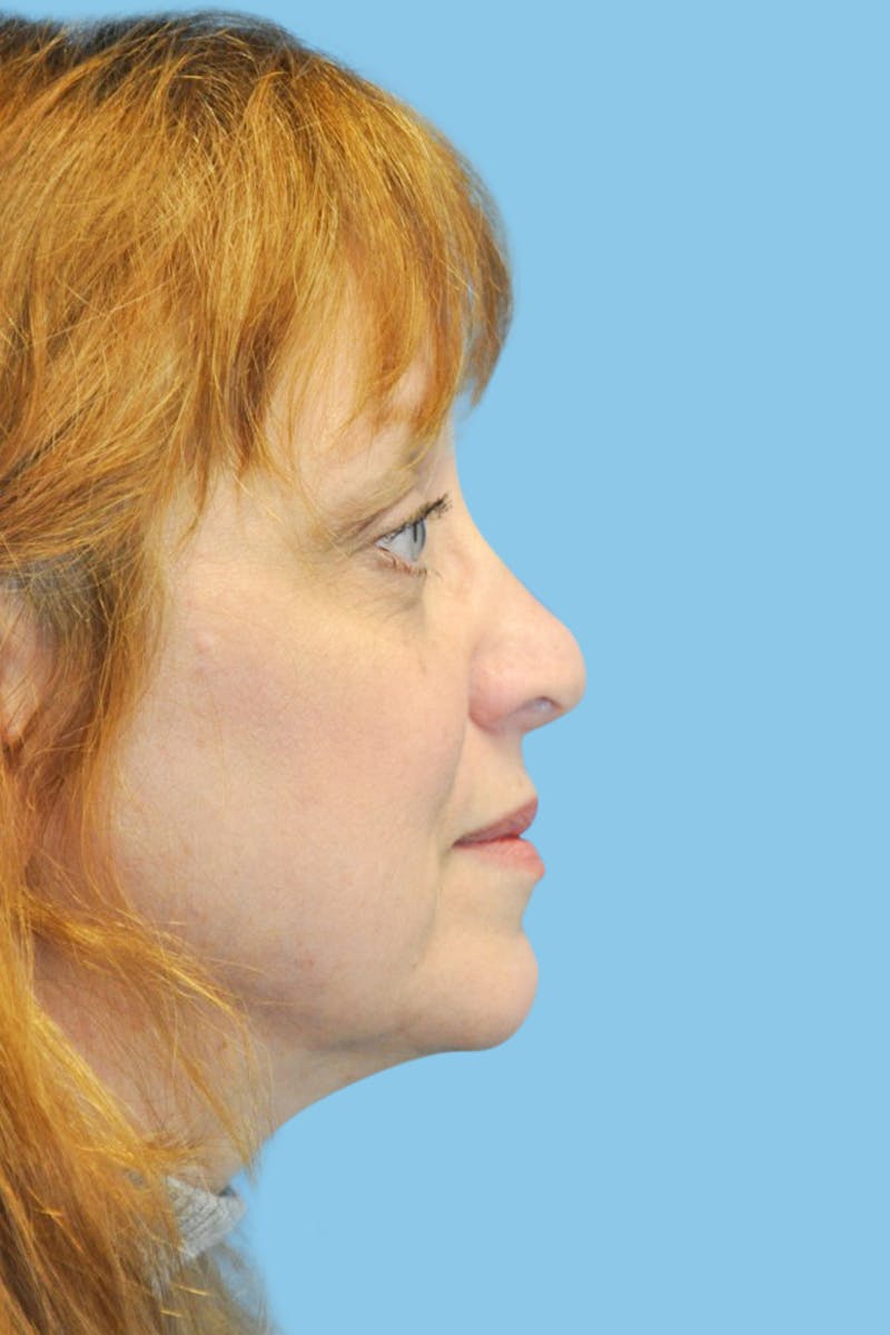 Revision Rhinoplasty Before & After Gallery - Patient 141207 - Image 3
