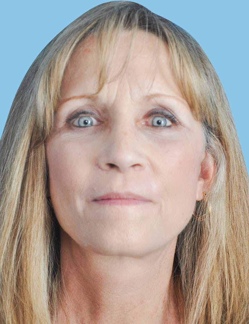Facelift & Necklift Before & After Gallery - Patient 229190 - Image 2