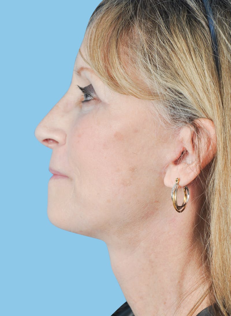 Facelift & Necklift Before & After Gallery - Patient 229190 - Image 4