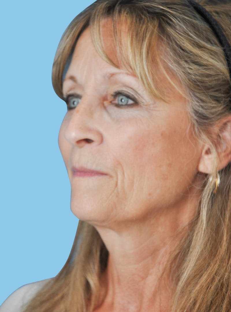Facelift & Necklift Before & After Gallery - Patient 229190 - Image 5