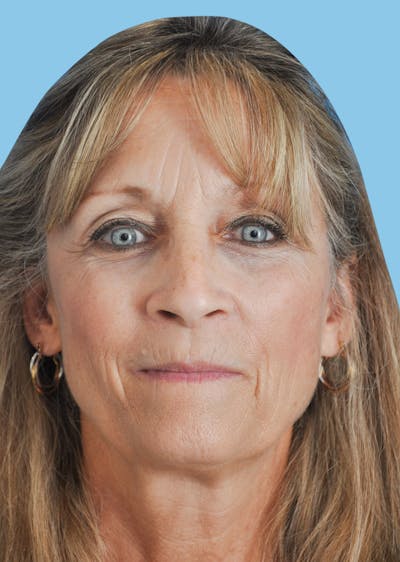 SWIFT LIFT ® / Facelift / Necklift  Before & After Gallery - Patient 229190 - Image 1