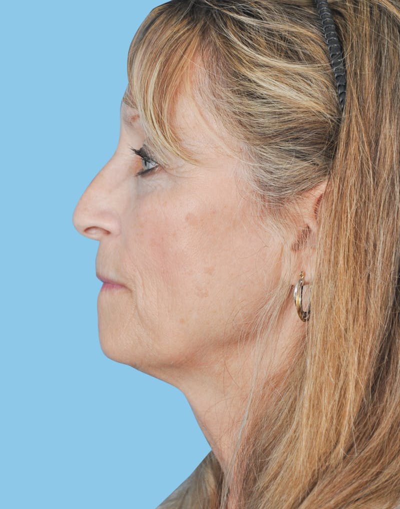 Facelift & Necklift Before & After Gallery - Patient 229190 - Image 3