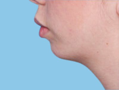 Chin Augmentation Before & After Gallery - Patient 299802 - Image 1