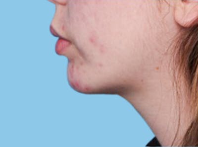 Chin Augmentation Before & After Gallery - Patient 299802 - Image 2