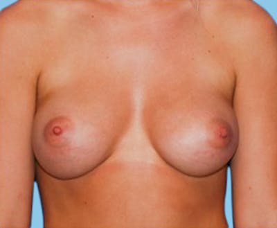 Breast Augmentation Before & After Gallery - Patient 426249 - Image 2