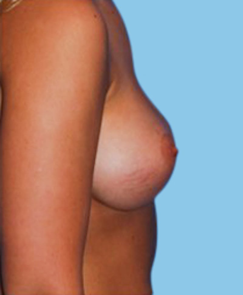 Breast Augmentation Before & After Gallery - Patient 426249 - Image 4
