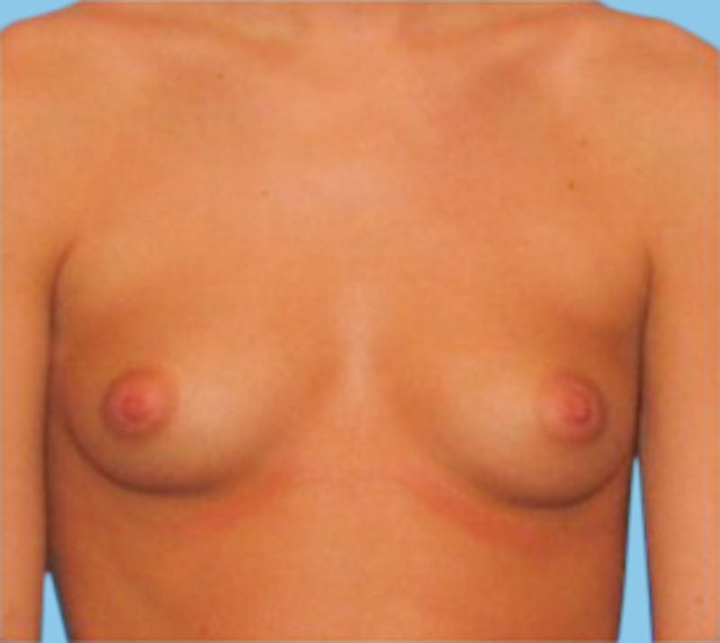 Breast Augmentation Before & After Gallery - Patient 426249 - Image 1