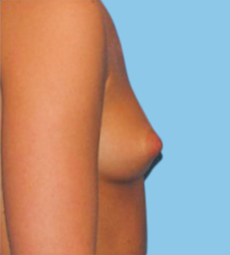 Breast Augmentation Before & After Gallery - Patient 426249 - Image 3