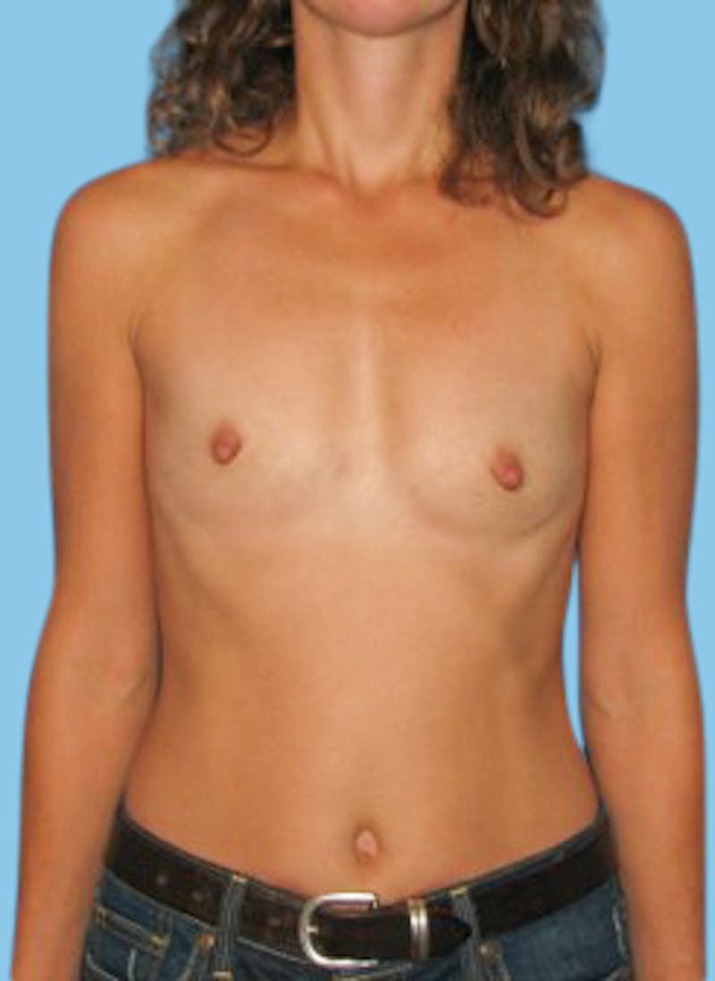 Breast Augmentation Before & After Gallery - Patient 321651 - Image 1