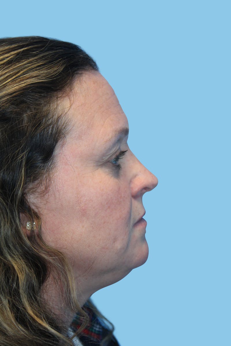 Rhinoplasty Before & After Gallery - Patient 317073 - Image 4