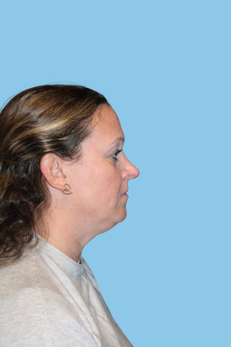 Rhinoplasty Before & After Gallery - Patient 317073 - Image 3