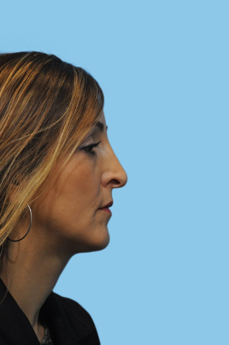 Rhinoplasty Before & After Gallery - Patient 299846 - Image 3