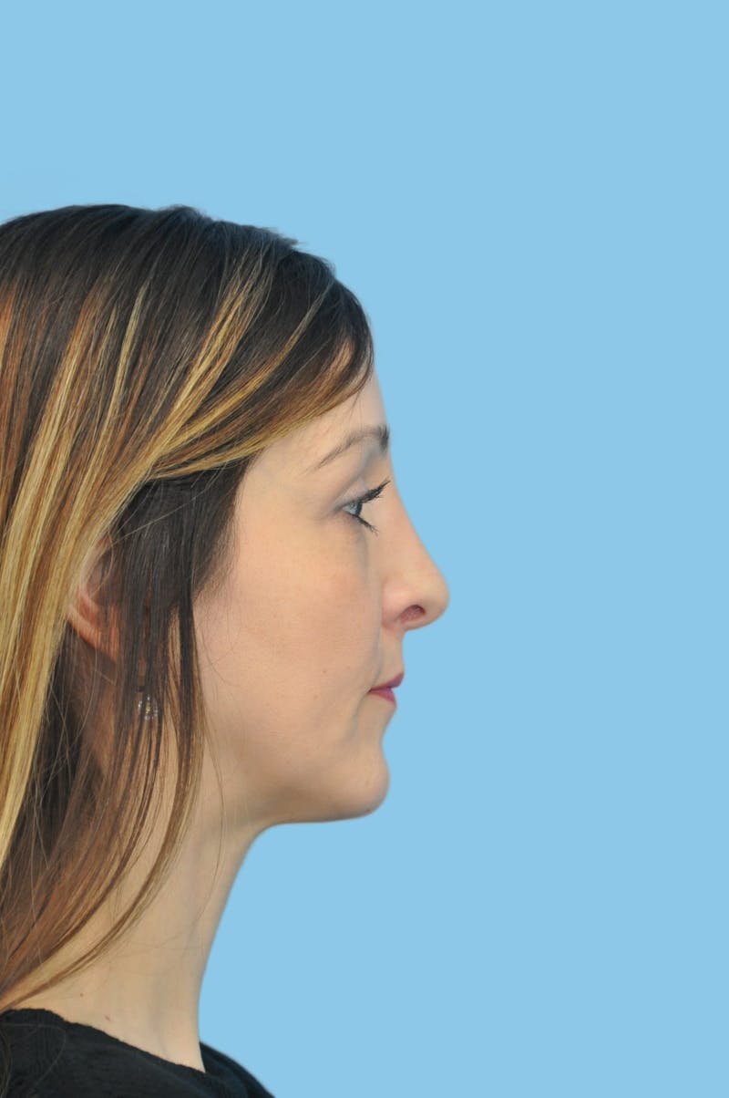 Rhinoplasty Before & After Gallery - Patient 299846 - Image 4
