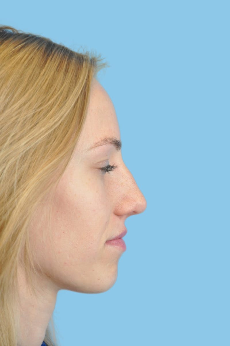 Rhinoplasty Before & After Gallery - Patient 899669 - Image 3