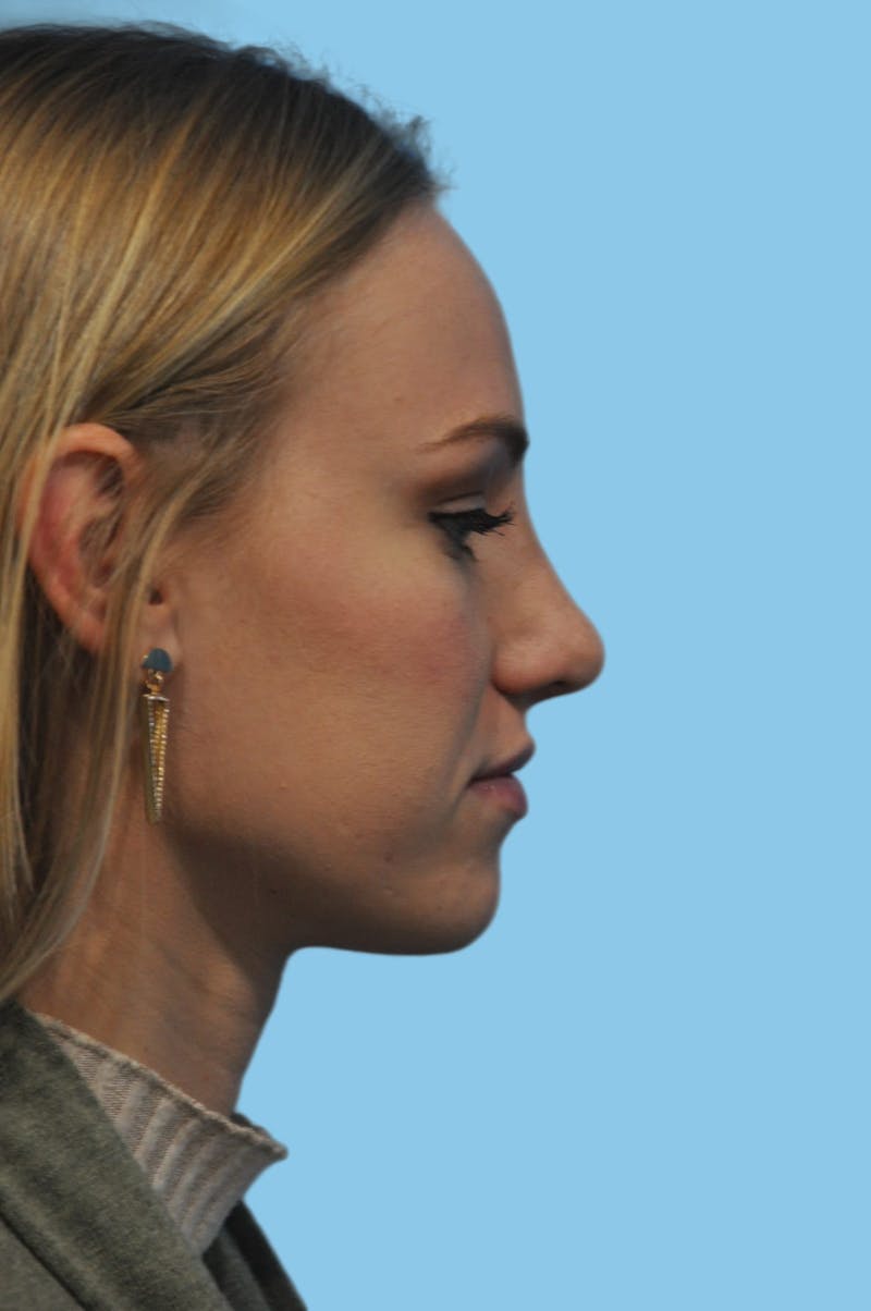 Rhinoplasty Before & After Gallery - Patient 899669 - Image 4