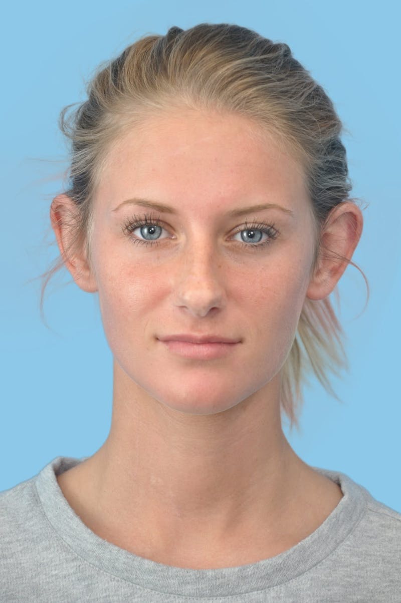 Rhinoplasty Before & After Gallery - Patient 167653 - Image 1