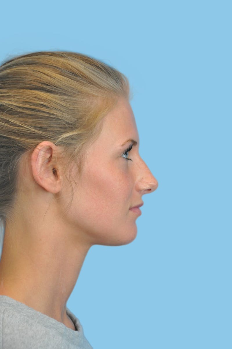 Rhinoplasty Before & After Gallery - Patient 167653 - Image 3