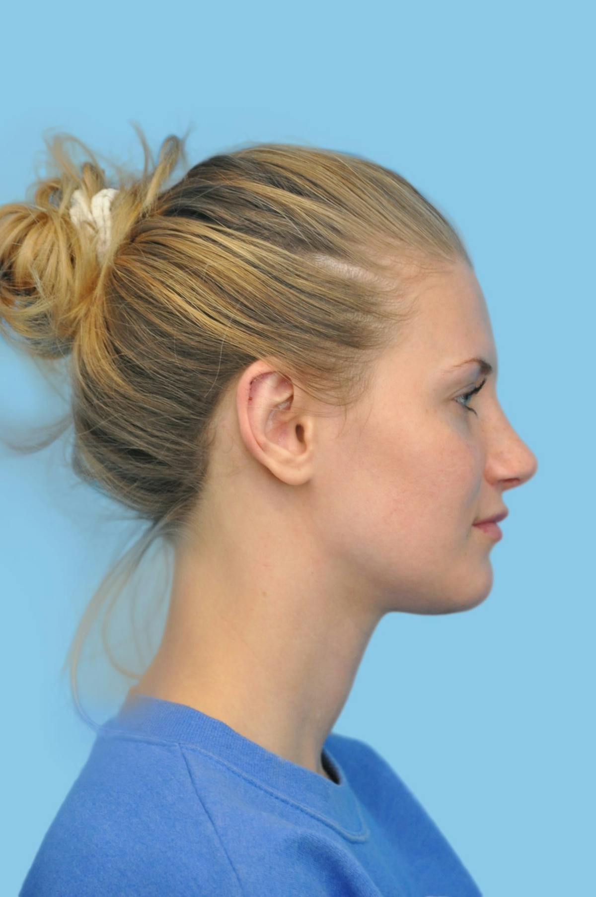 Ear Surgery Before & After Gallery - Patient 102858 - Image 4