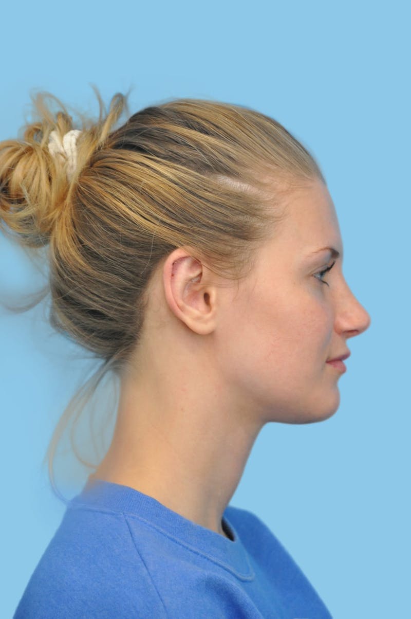 Rhinoplasty Before & After Gallery - Patient 167653 - Image 4