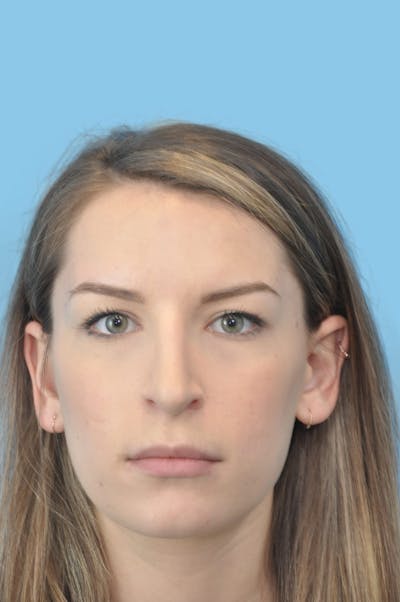 Rhinoplasty Before & After Gallery - Patient 225273 - Image 2