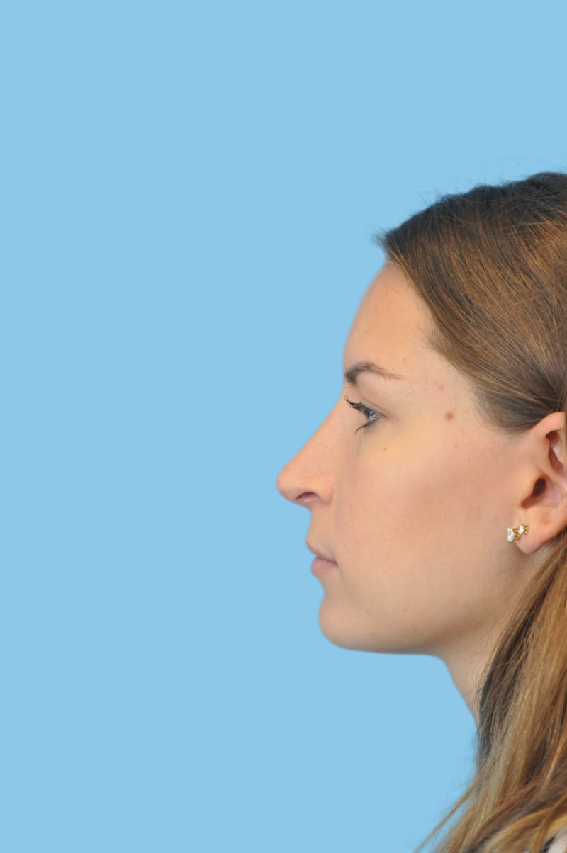 Rhinoplasty Before & After Gallery - Patient 225273 - Image 4