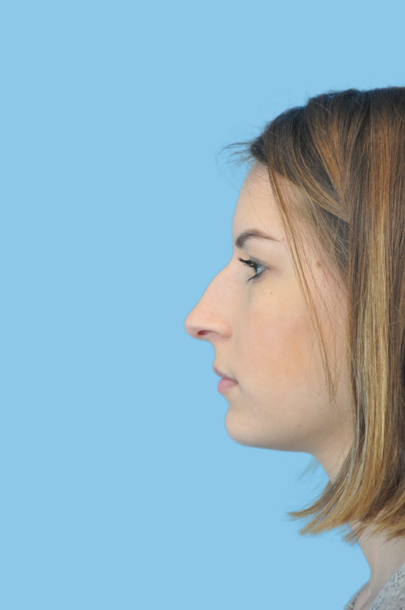 Rhinoplasty Before & After Gallery - Patient 225273 - Image 3