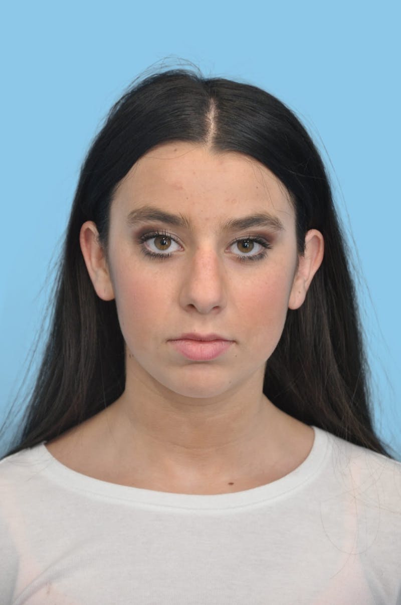 Rhinoplasty Before & After Gallery - Patient 322831 - Image 1
