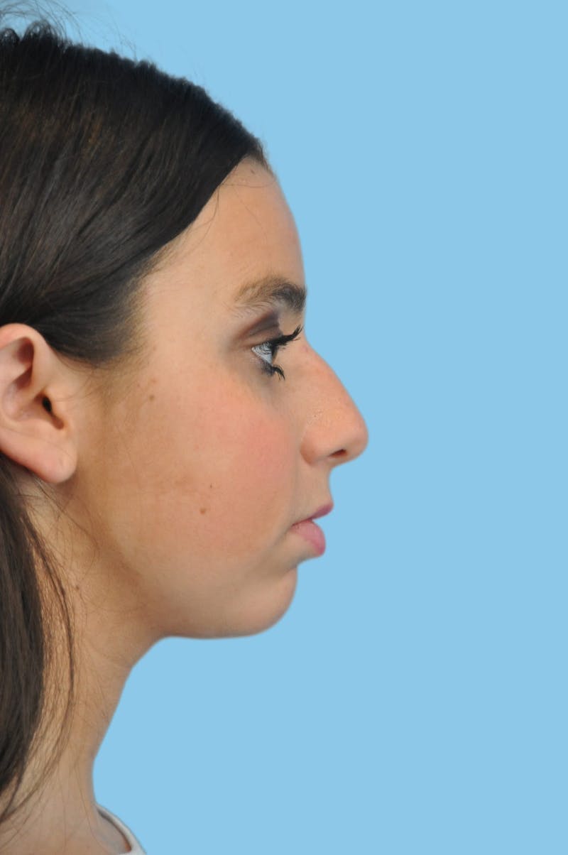 Rhinoplasty Before & After Gallery - Patient 322831 - Image 3