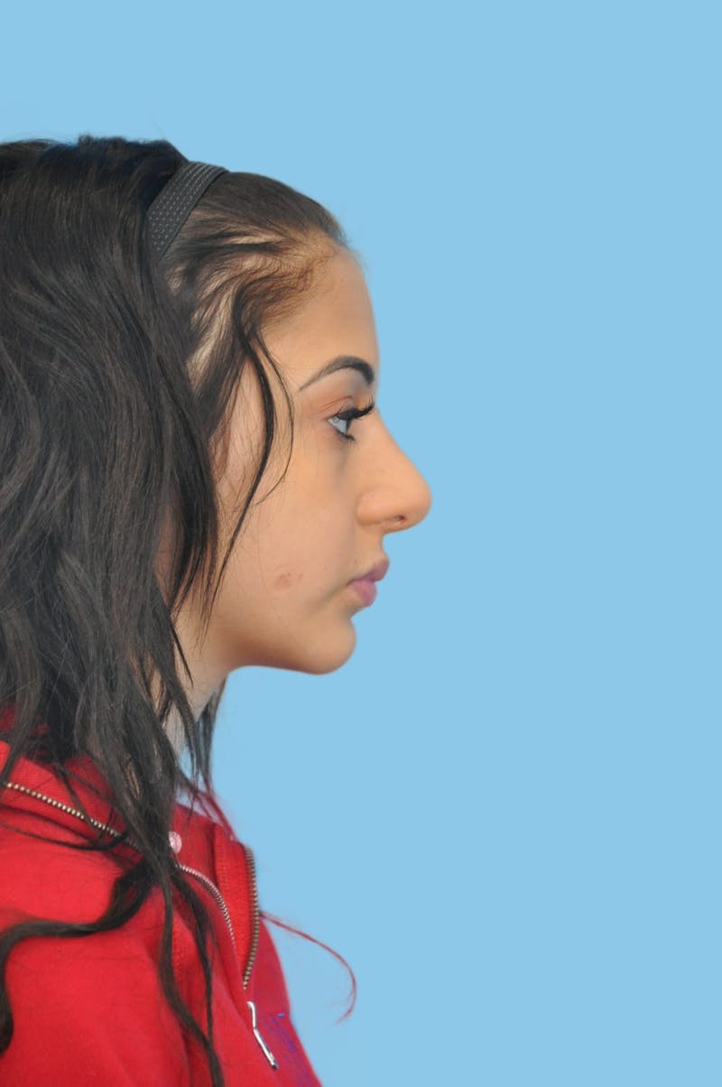 Rhinoplasty Before & After Gallery - Patient 245614 - Image 3