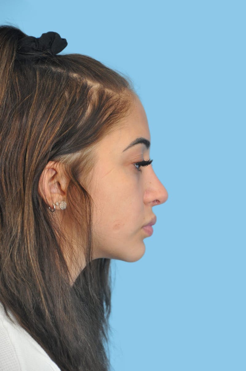 Rhinoplasty Before & After Gallery - Patient 245614 - Image 4