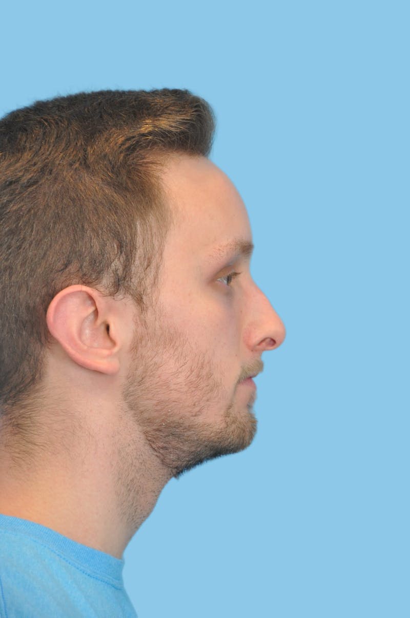 Rhinoplasty Before & After Gallery - Patient 115720 - Image 3