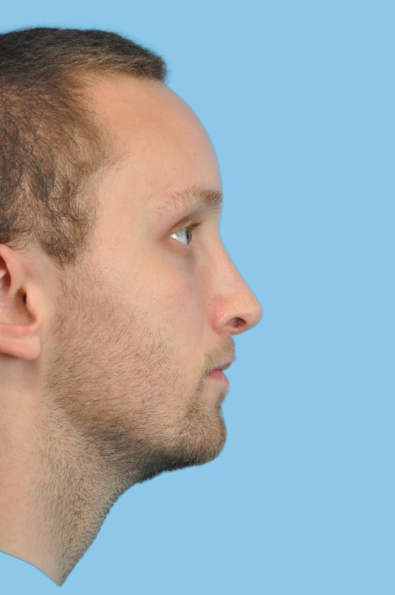 Rhinoplasty Before & After Gallery - Patient 115720 - Image 4