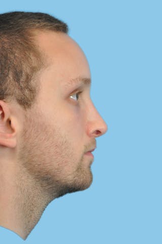 Rhinoplasty Before & After Gallery - Patient 115720 - Image 4