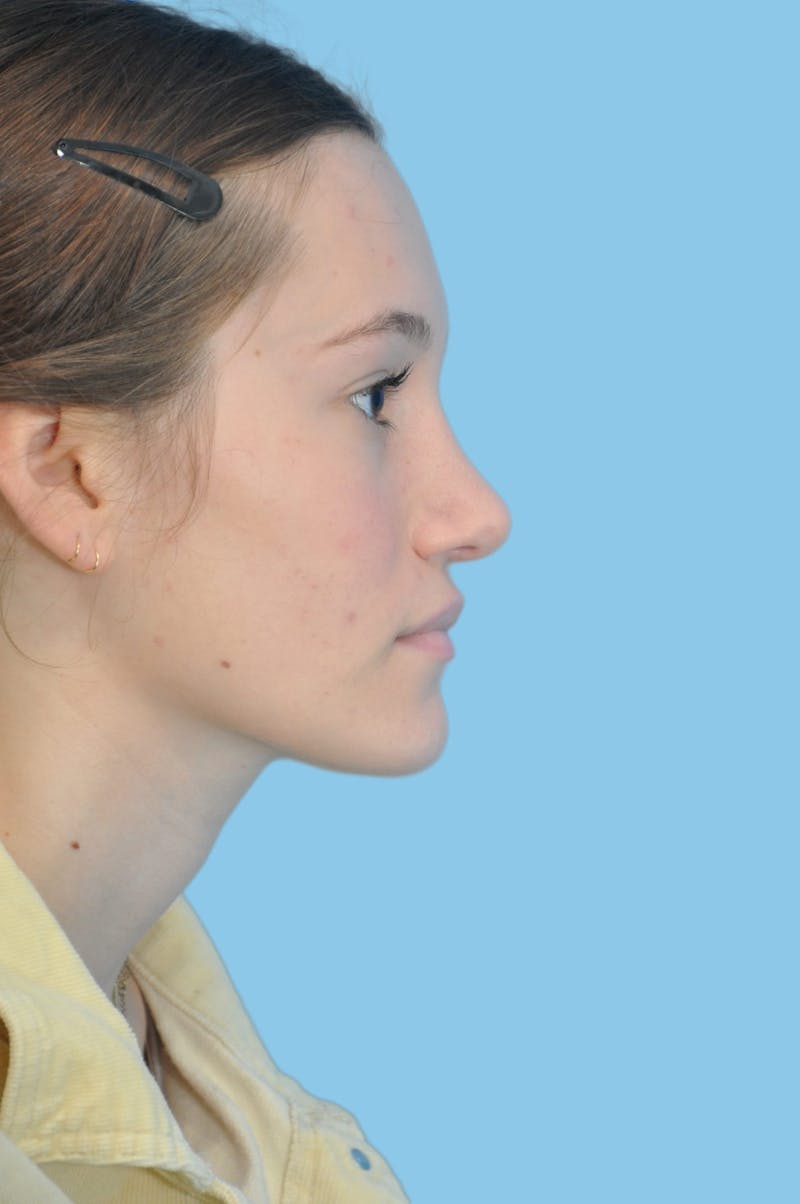 Rhinoplasty Before & After Gallery - Patient 208464 - Image 4