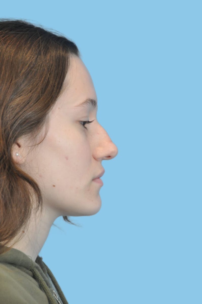 Rhinoplasty Before & After Gallery - Patient 208464 - Image 3