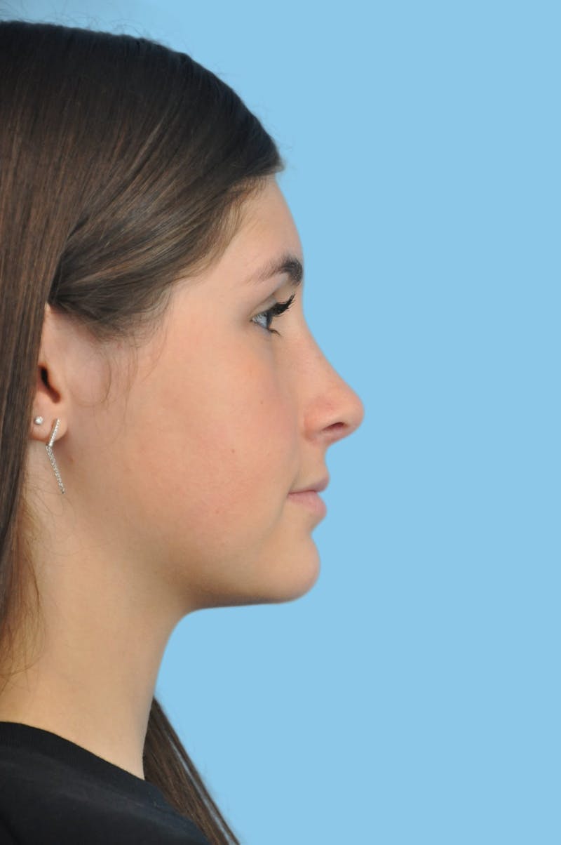 Rhinoplasty Before & After Gallery - Patient 143782 - Image 4