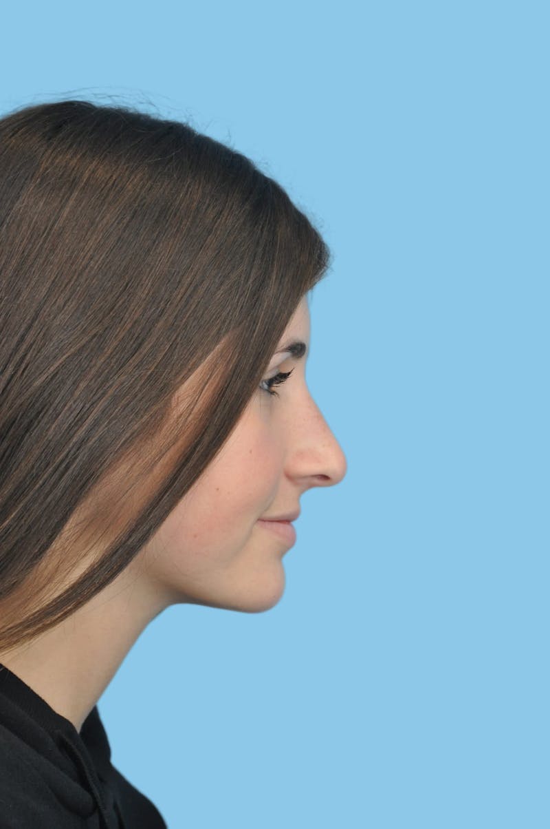 Rhinoplasty Before & After Gallery - Patient 143782 - Image 3