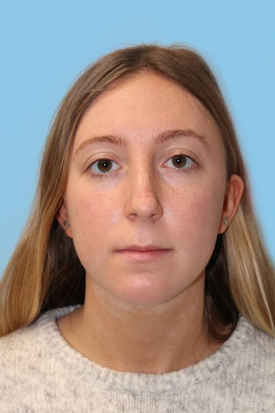 Rhinoplasty Before & After Gallery - Patient 353354 - Image 1