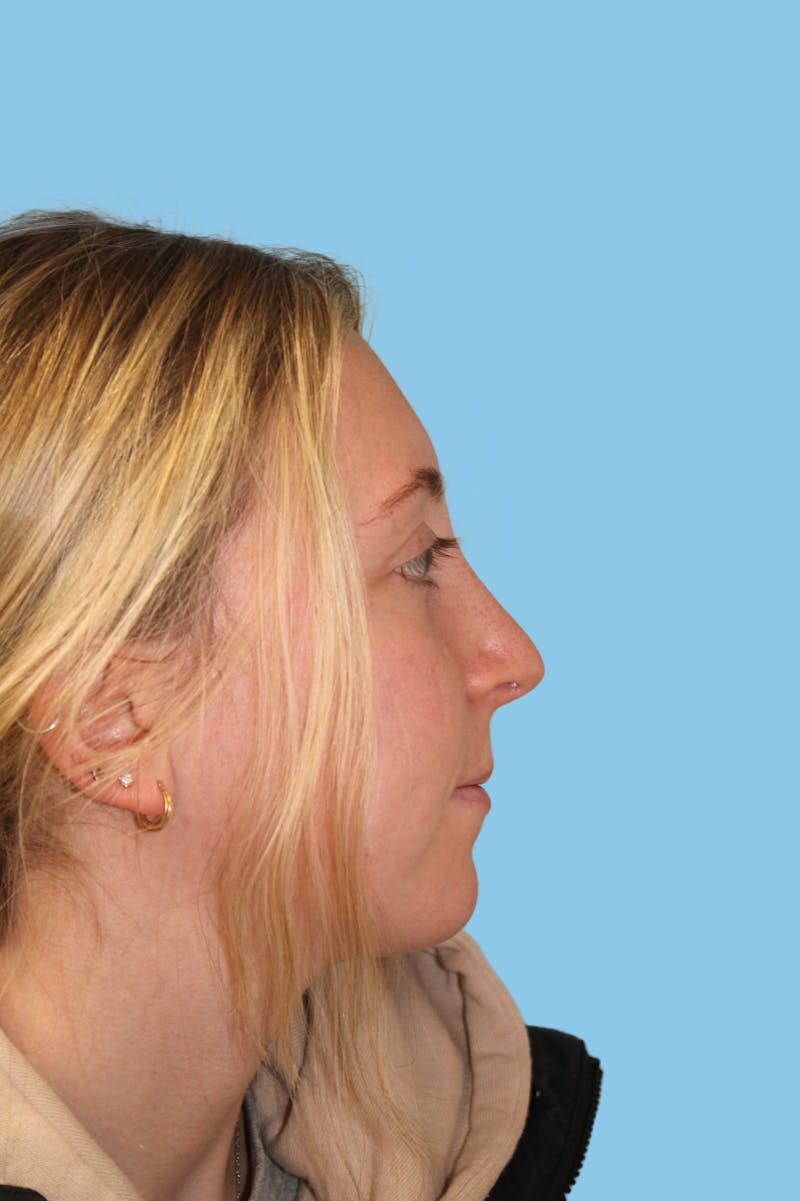 Rhinoplasty Before & After Gallery - Patient 353354 - Image 4