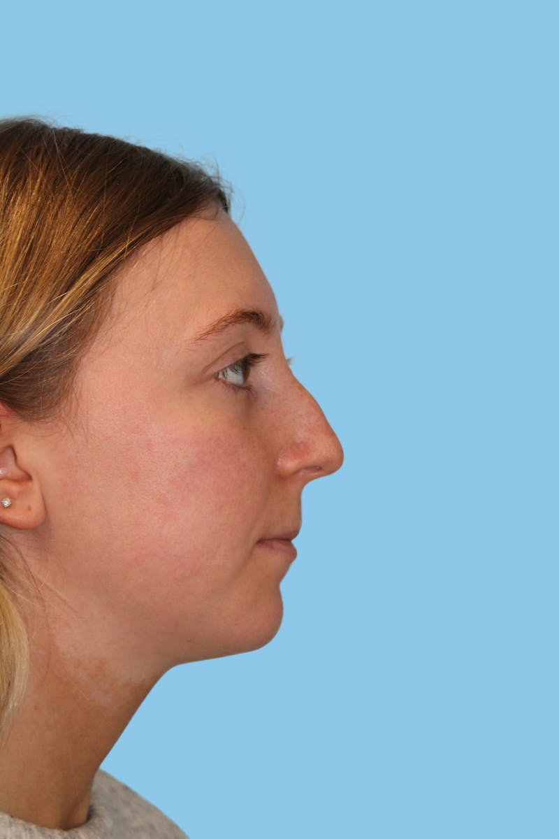 Rhinoplasty Before & After Gallery - Patient 353354 - Image 3