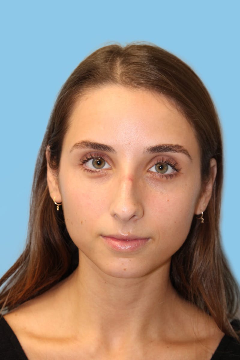 Rhinoplasty Before & After Gallery - Patient 166275 - Image 1