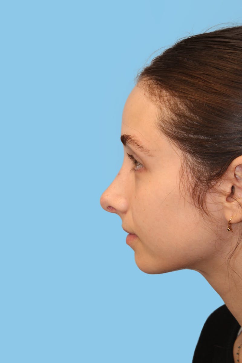 Rhinoplasty Before & After Gallery - Patient 166275 - Image 4