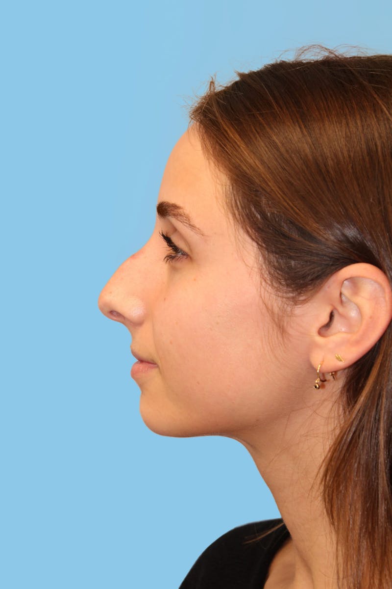 Rhinoplasty Before & After Gallery - Patient 166275 - Image 3