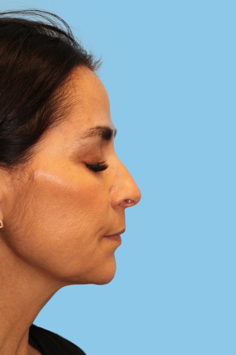 Rhinoplasty Before & After Gallery - Patient 402156 - Image 3