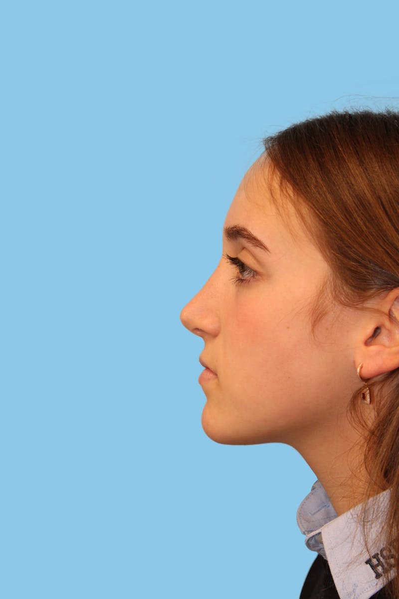 Rhinoplasty Before & After Gallery - Patient 477824 - Image 4