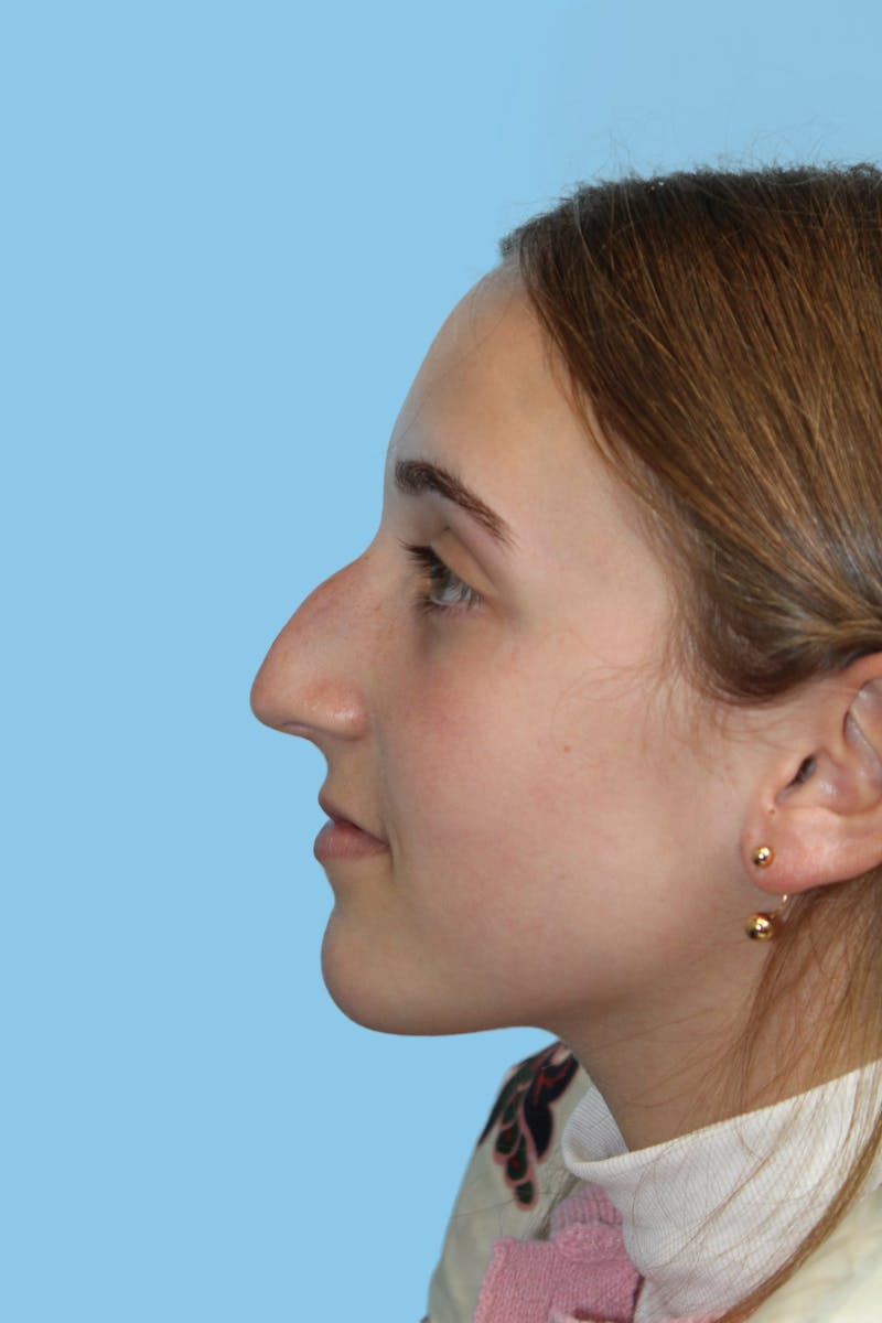 Rhinoplasty Before & After Gallery - Patient 477824 - Image 3